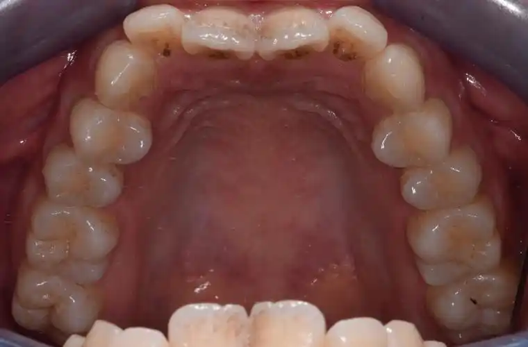 侧切牙垂直向开颌3mm;2,上颌相对下颌偏窄,只有磨牙有咬合接触,后牙