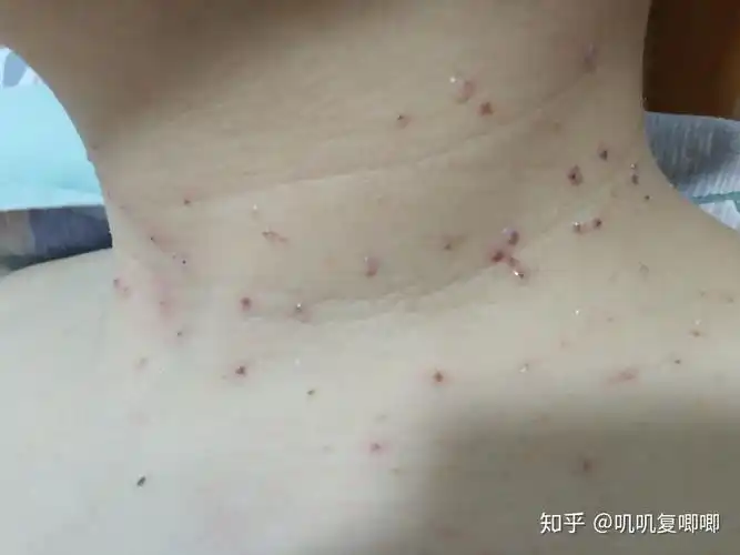 丝状疣,脖子上,女性,医生说要激光扫,有别的办法吗? - 知乎