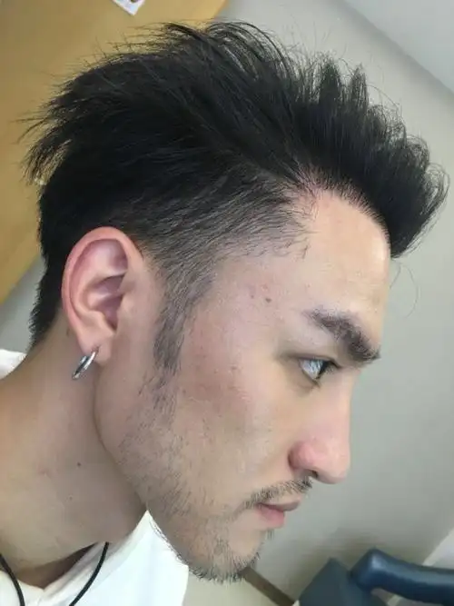 种植胡须术后1年2018118