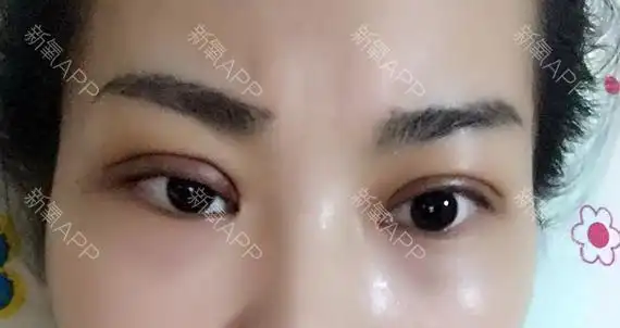 埋线双眼皮第十天为什么左眼还一直肿着呢右眼恢复的还_圈子-新氧美容