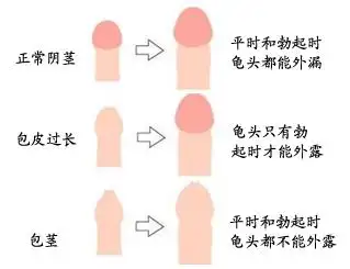 扬州包茎有什么症状