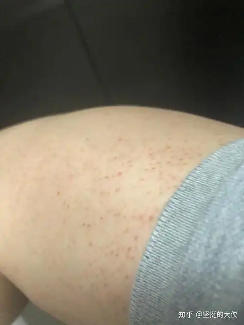 皮肤科专家有吗毛囊炎的