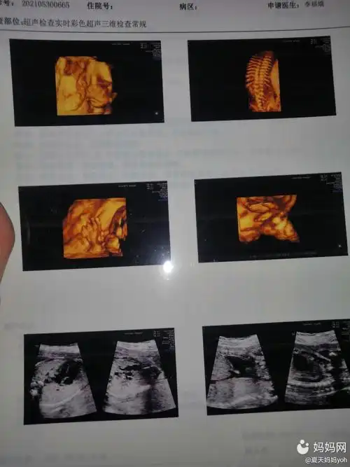 四维一次通过,问医生眼睛大不大?