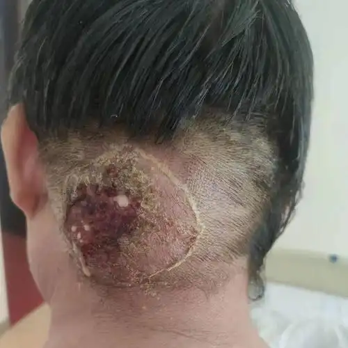 【健康关注】小小疖肿莫大意,及时就医很关键!