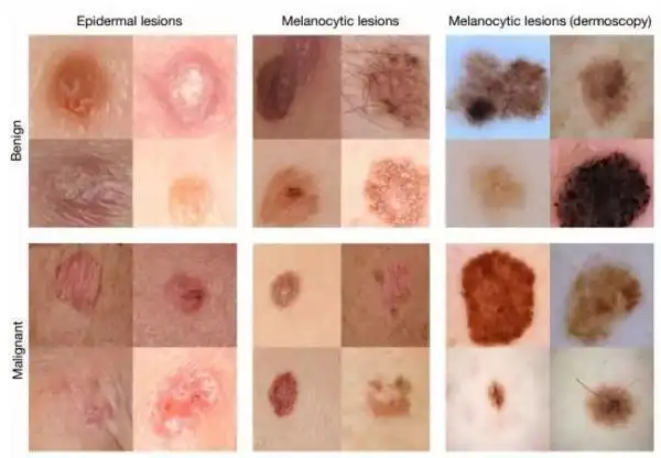 滚动新闻  图片样本:良性和恶性的上皮细胞/黑色素细胞/皮肤镜下的黑