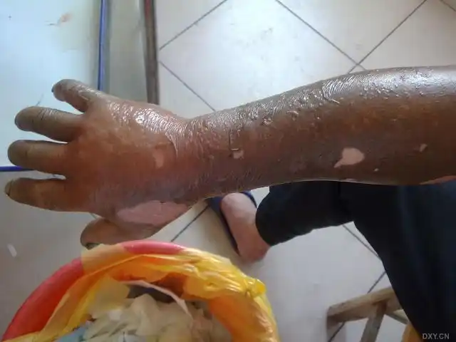 电火花烧伤7%浅二度