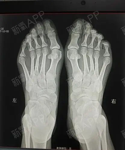 我脚的问题有点多,不仅有大脚骨,还有脚趾畸形,小脚_圈子-新氧美容