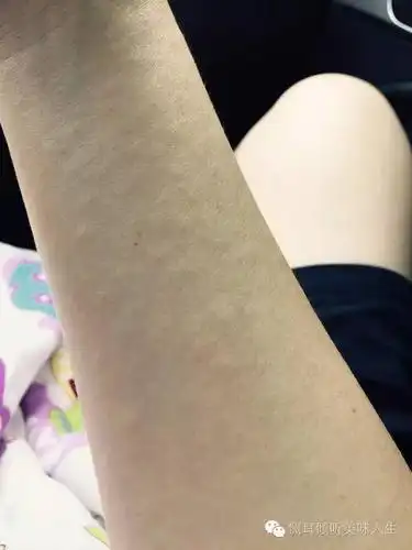 也许是水土不服,也许是其他粉尘过敏,不清楚诱因,以前从未有过,只