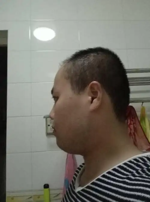 年纪轻轻就脱发成这个样子,让我非常苦恼,如果我去剃光头这种头型能