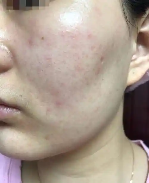面部皮肤敏感发烫长红斑起小疹子