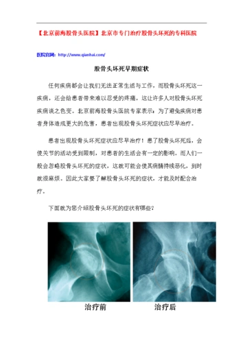 股骨头坏死早期症状.docx
