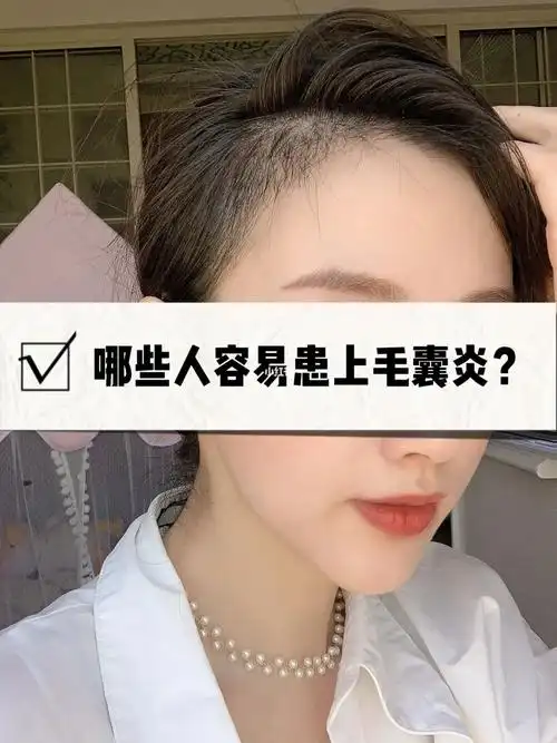 科普!头皮毛囊炎会引起脱发吗?