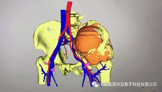紫薇帝星助力中科大附属第一医院西区骨科成功实施保肢手术