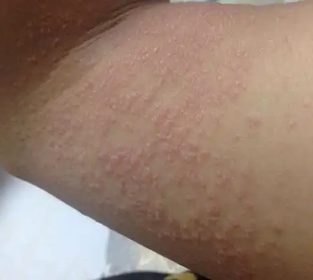 干性湿疹图片 (5)_有来医生