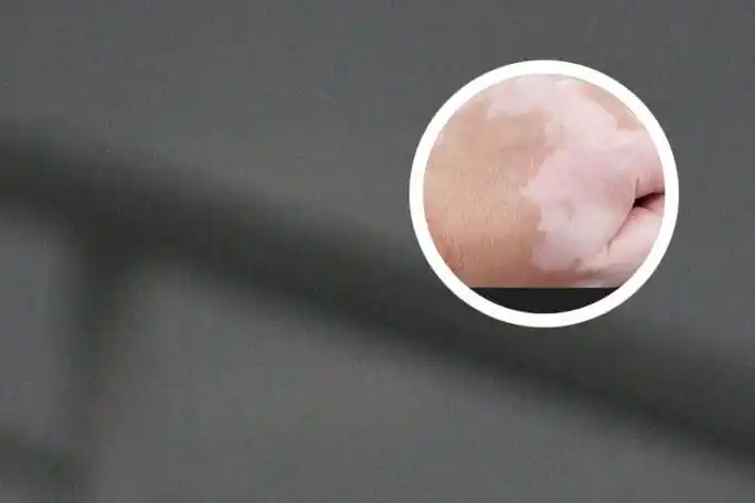 白斑有什么症状表现