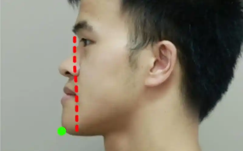 鞋拔子脸男生,下巴太长不好看,矫正后又奶又帅