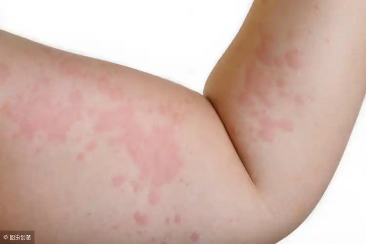 反复过敏心烦意乱?静下心来做这6件事,很快能好转