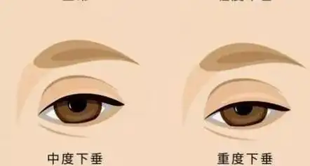 上眼睑下垂之后还能恢复吗?手术费用|矫正|怎么改善|什么原因