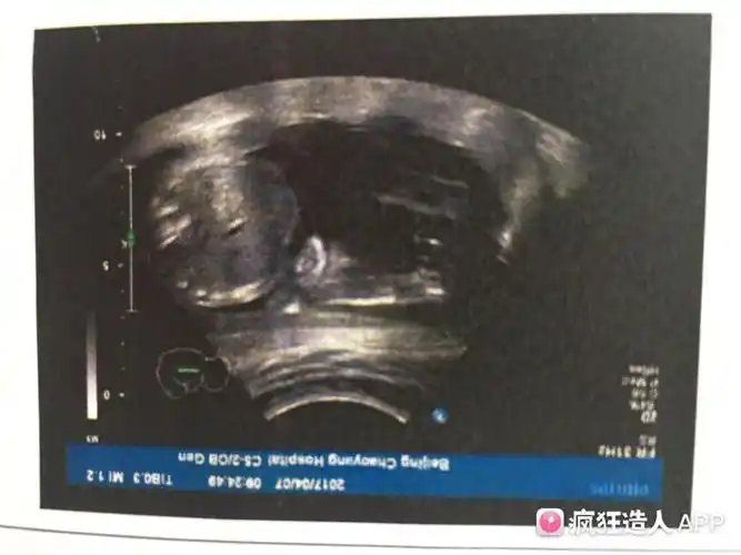 [试管婴儿]b 超图 大神帮看看是传说中的三条线么?