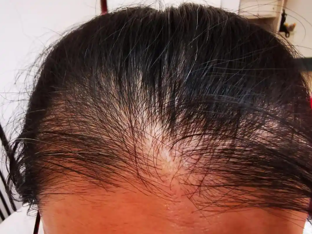 产后脱发的姐妹们,集合了.乱纷纷你方掉罢我也掉,头皮秃秃好认 - 抖音