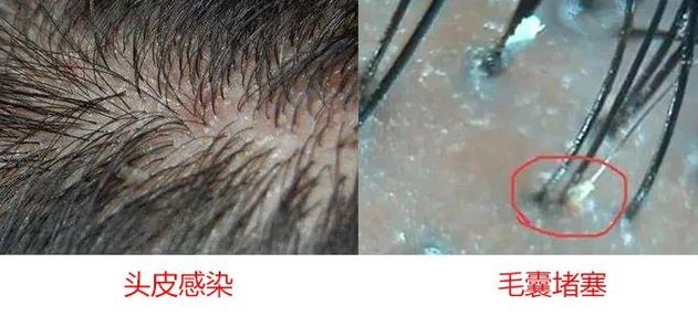 健康的头皮,每根头发都应该是粗粗壮壮的,每个毛囊内都会有2~3根头发.