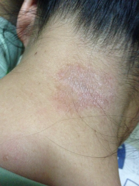 脖子那里这两年夏天就有点痒,干,怎么回事?