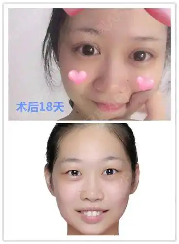 手术了吧,要说我从小到大的梦想就是变成大眼睛双眼皮,连明星变成单