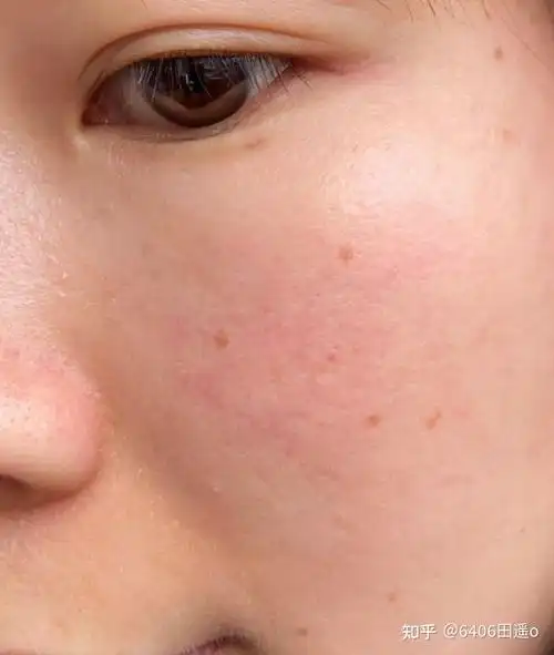 红血丝肌肤怎么修复? - 知乎