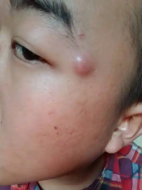 眼睛旁边长了个豆豆一样的小包 有点发红 稍微有点硬 是什么东西啊?