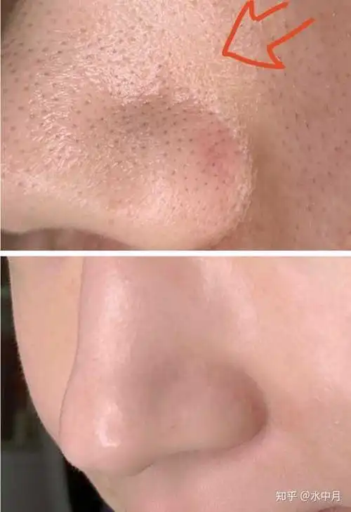 以 选那些有迷迭香叶,虎杖根,光果甘草这些对黑头,毛孔