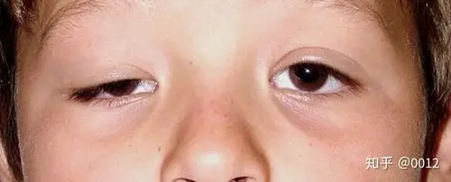 轻微的重症肌无力一般表现为眼睛有些下垂,四肢无力,提一些重物就感觉