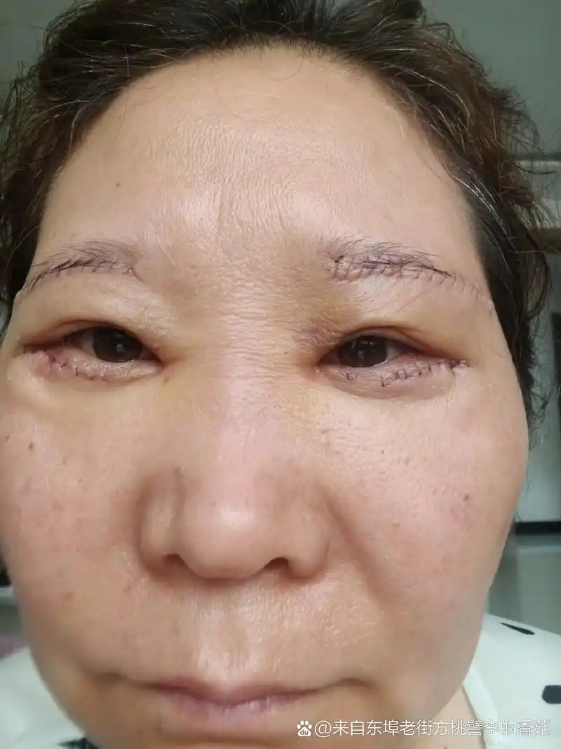 今天是做了提眉和去眼袋手术的第三天,稍微消肿了,但眼睛还是肿胀的