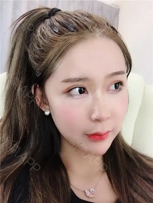 娄底自体脂肪全脸填充好不好_效果图_氧气kd382da自体脂肪全脸填充术