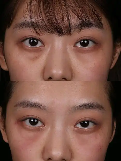 玻尿酸填充泪沟术后即刻