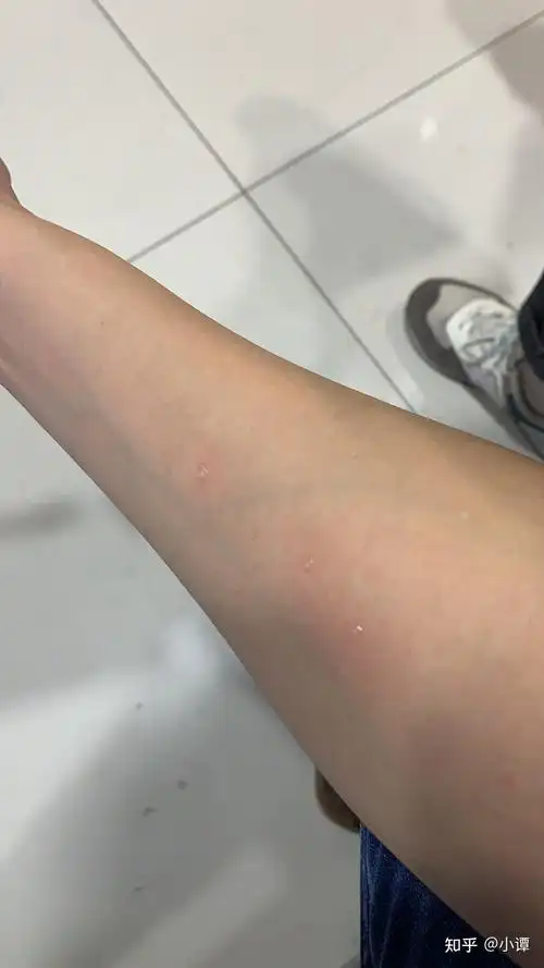 尘螨过敏性鼻炎,畅迪脱敏治疗记录(第一周) - 知乎