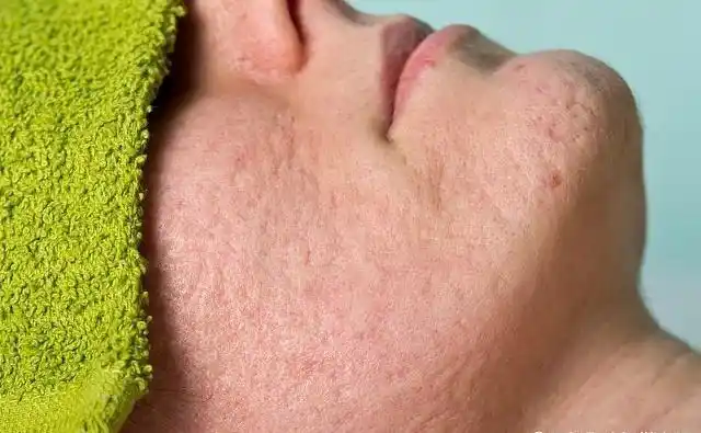 角质层太厚有什么坏处!不知道的妹子可以点进来看下