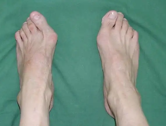 严重的拇外翻图片(二) - 好大夫在线