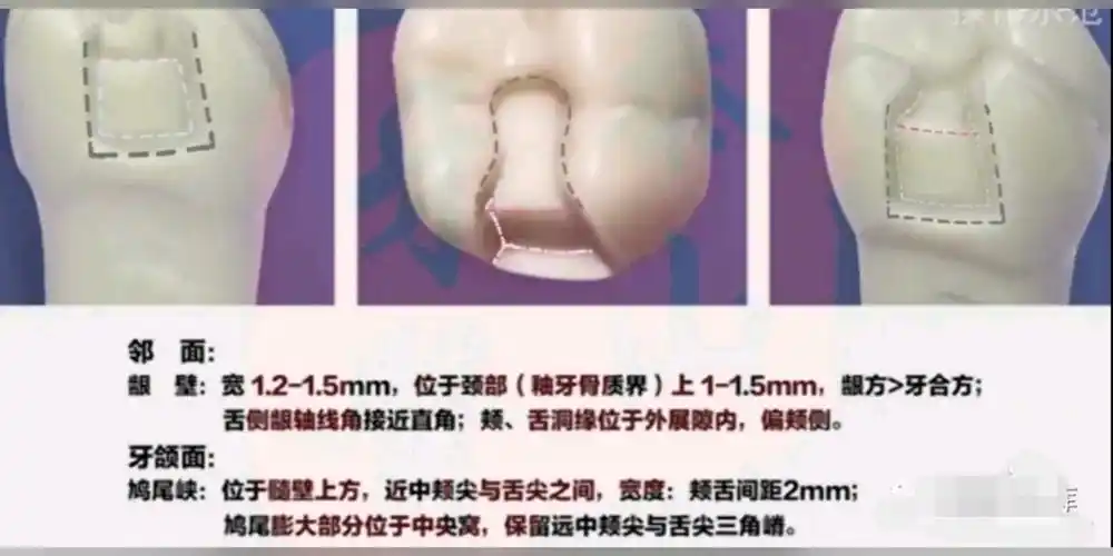 二类洞预备标准图解