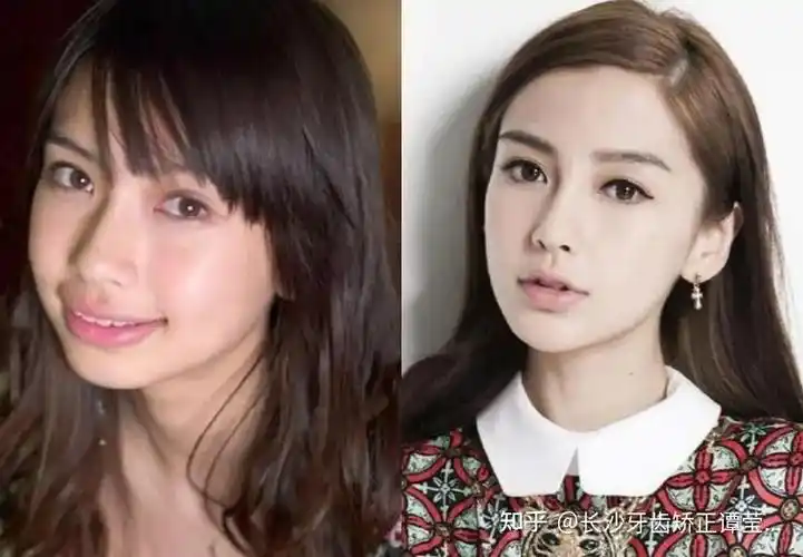 戴牙套会改变脸型吗?