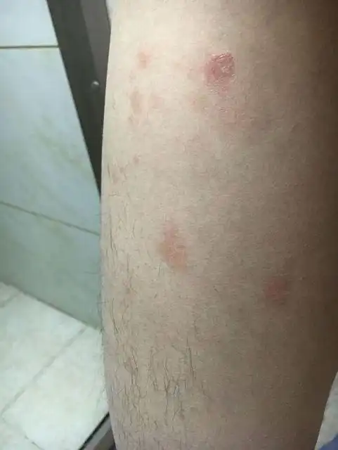 牛皮肤癣的图片