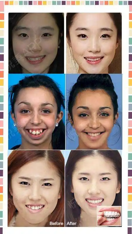 免费招募上海站隐形牙套试戴30名