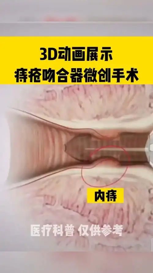 3d动画展示痔疮吻合器创维手术