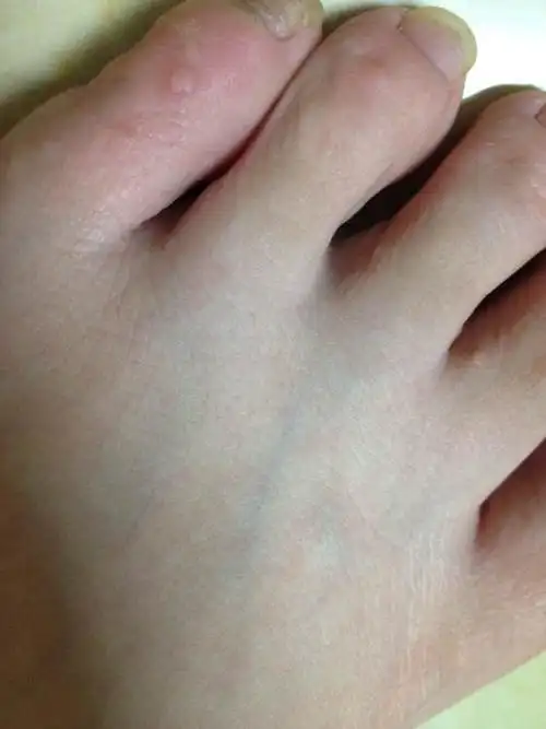 这种长在脚上的扁平疣会传染到脸上吗