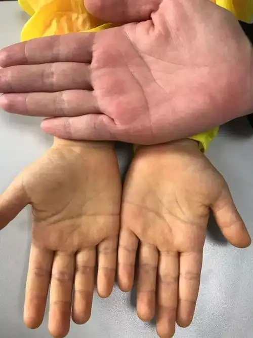 手脚心发黄的小黄人