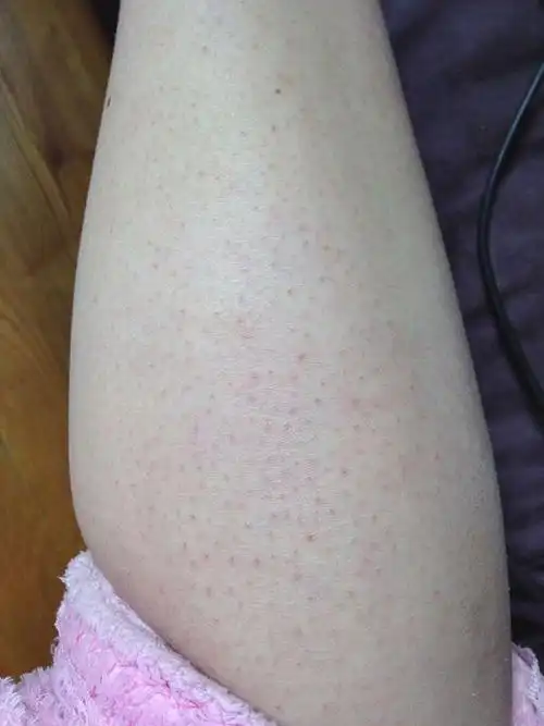 小腿皮肤为什么这样今年16岁