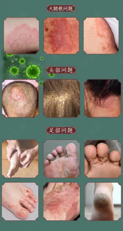 紫椒癣町酊顽固性脸部头皮全身皮肤干燥痒手脚私处瘙痒止痒膏共发10盒