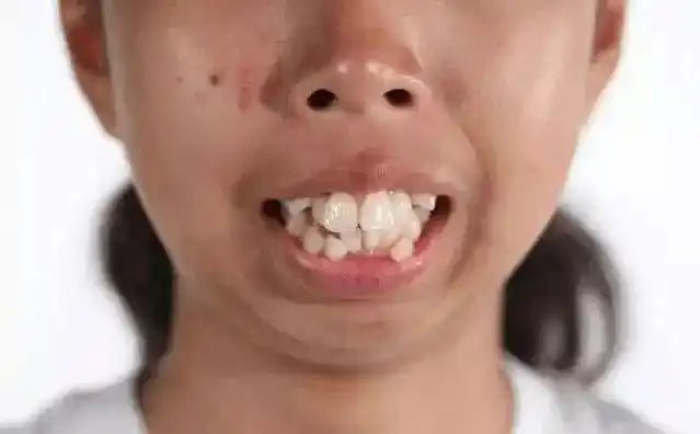 牙科经常说要给孩子定期检查牙齿是为了圈钱的套路还是