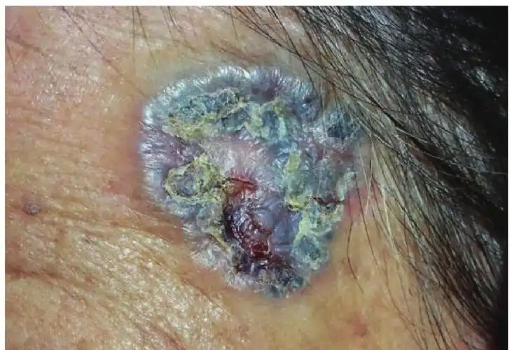 是最常见的皮肤恶性肿瘤,好发于身体的暴露部位特别是面部,来源于表皮