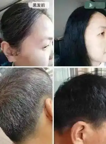 白头发千万别去店里染这样白发变黑发简单又健康年轻又漂亮