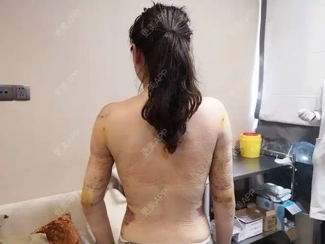 更美用户shyyflhsy2的吸脂日记